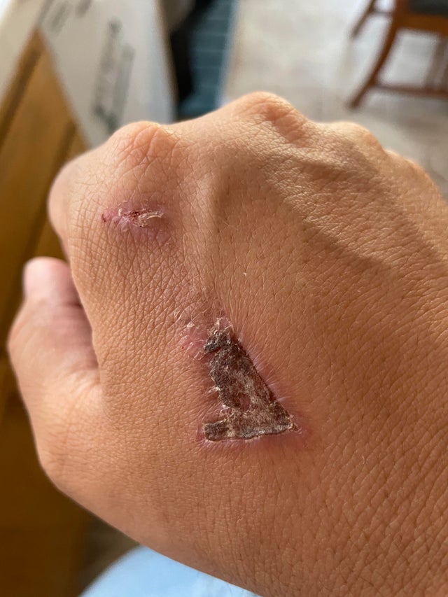 Doesn’t my scab look like a Raven sitting on a branch???🤪🚀🤪